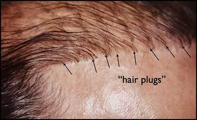 hair-plugs